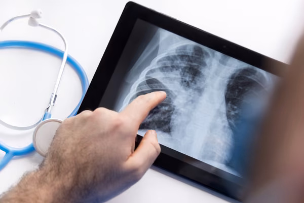 Chest x-ray bacterial pneumonia