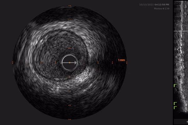 Intravascular Ultrasound (IVUS) cardiovascular imaging