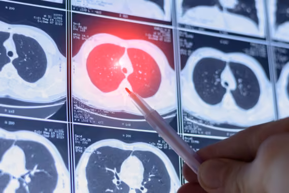 Lung cancer