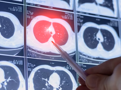 Lung cancer